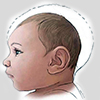 bebe-com-microcefalia